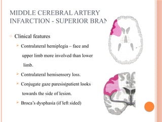 MIDDLE CEREBRAL ARTERY
INFARCTION - SUPERIOR BRANCH
o Clinical features
 Contralateral hemiplegia – face and
upper limb more involved than lower
limb.
 Contralateral hemisensory loss.
 Conjugate gaze paresis(patient looks
towards the side of lesion.
 Broca’s dysphasia (if left sided)
 