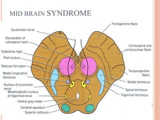 MID BRAIN SYNDROME
 