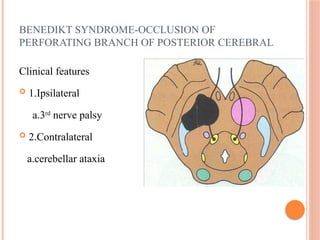 BENEDIKT SYNDROME-OCCLUSION OF
PERFORATING BRANCH OF POSTERIOR CEREBRAL
Clinical features
 1.Ipsilateral
a.3rd
nerve palsy
 2.Contralateral
a.cerebellar ataxia
 