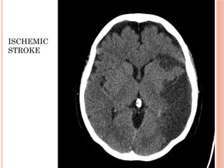 ISCHEMIC
STROKE
 