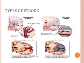 TYPES OF STROKE
 