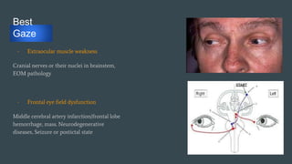 Best
Gaze
- Extraocular muscle weakness
Cranial nerves or their nuclei in brainstem,
EOM pathology
- Frontal eye field dysfunction
Middle cerebral artery infarction/frontal lobe
hemorrhage, mass. Neurodegenerative
diseases, Seizure or postictal state
 