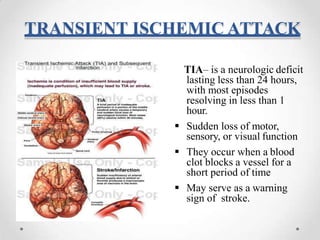 Fast Tia stroke causes sign symptoms treatment nursing management | PPTX