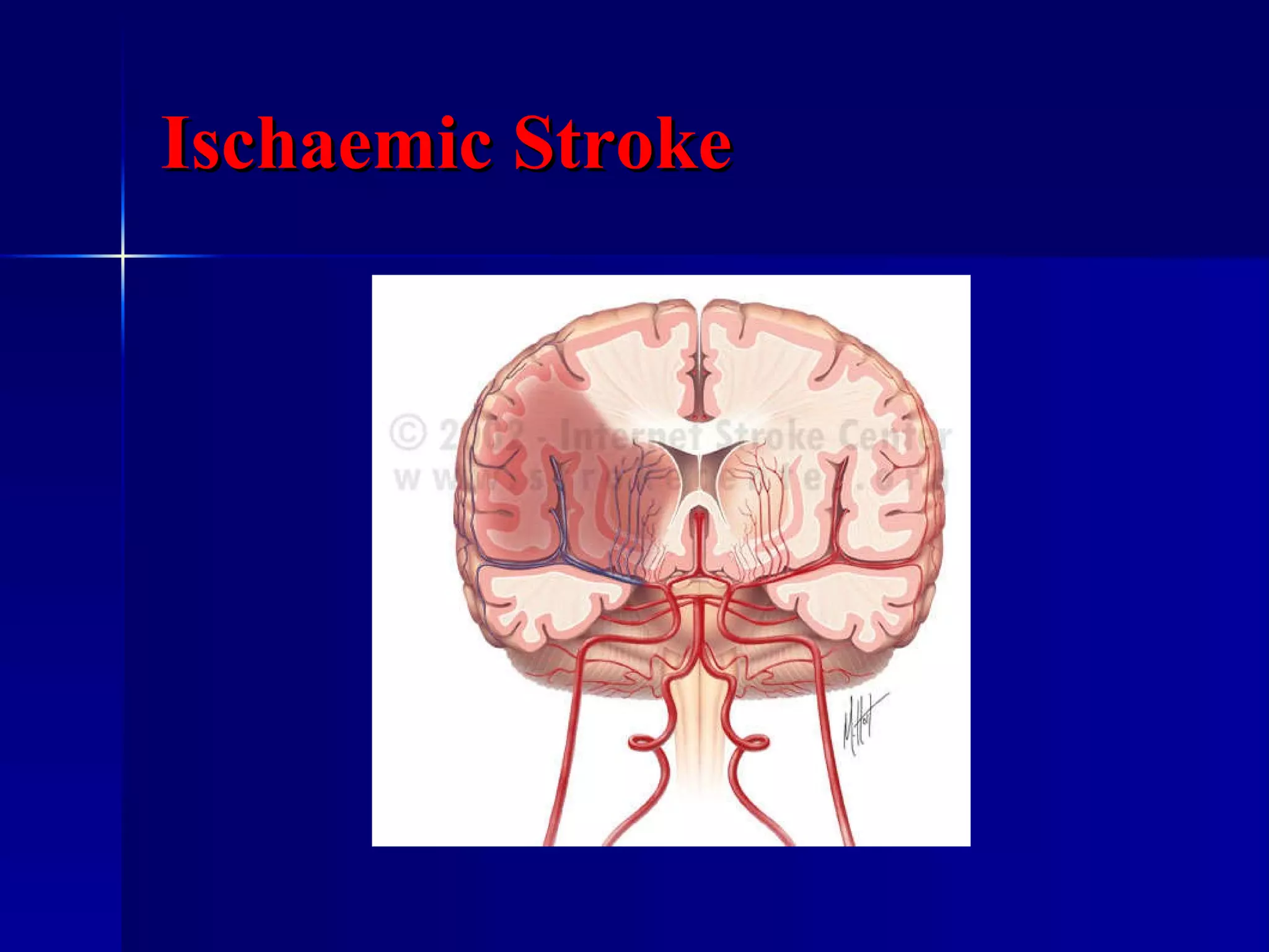 Ischaemic Stroke 