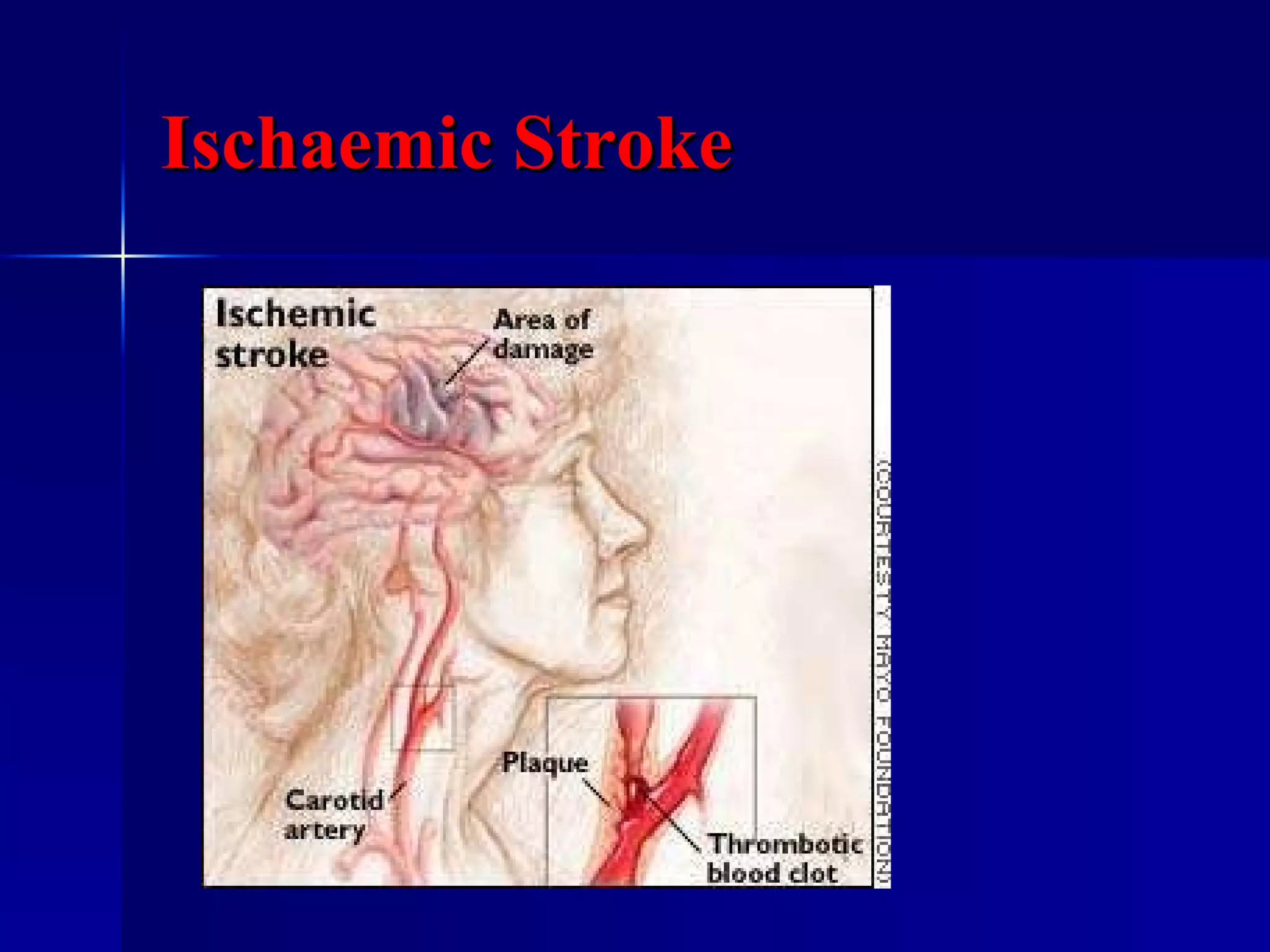 Ischaemic Stroke 