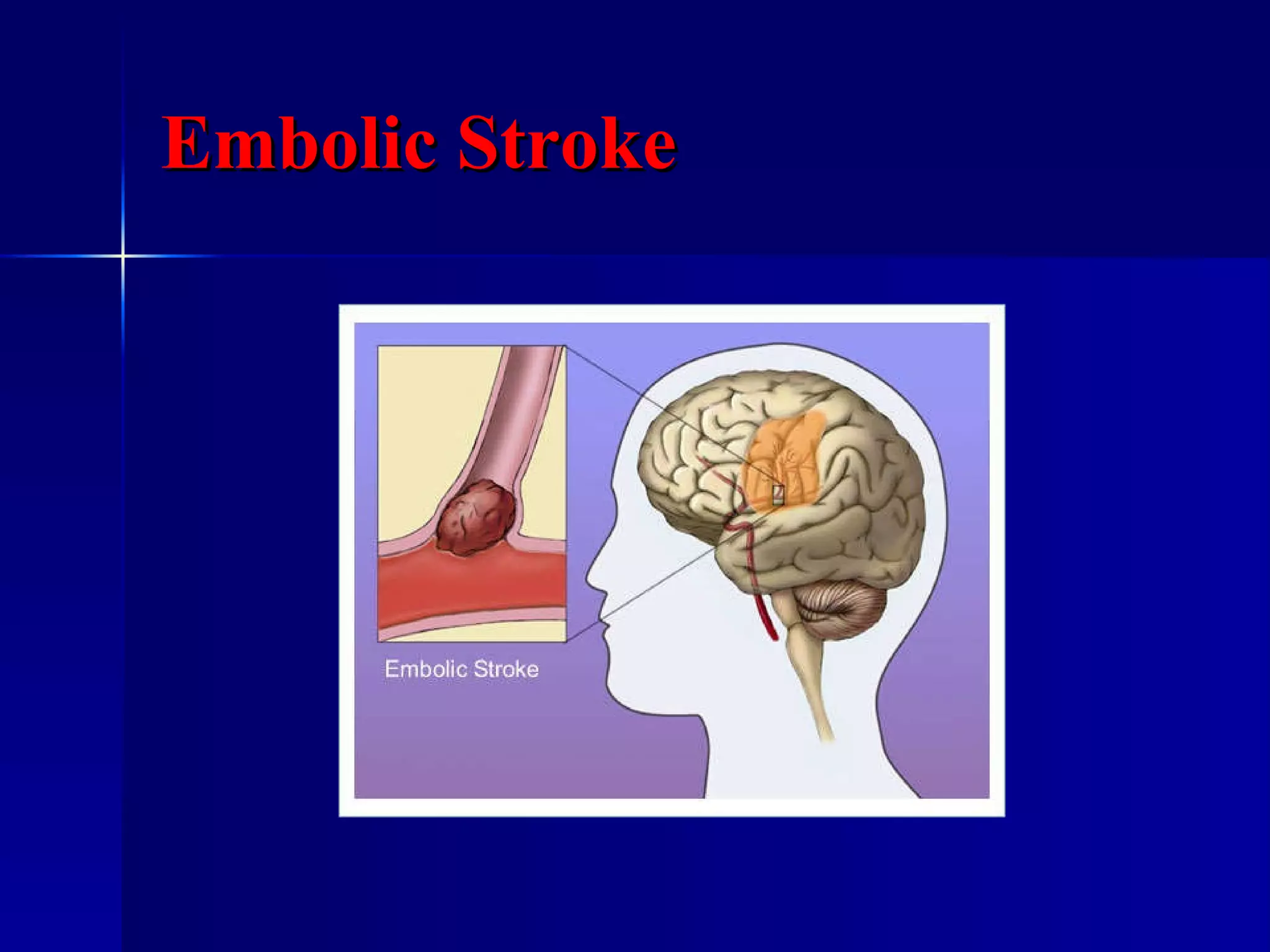 Embolic Stroke 