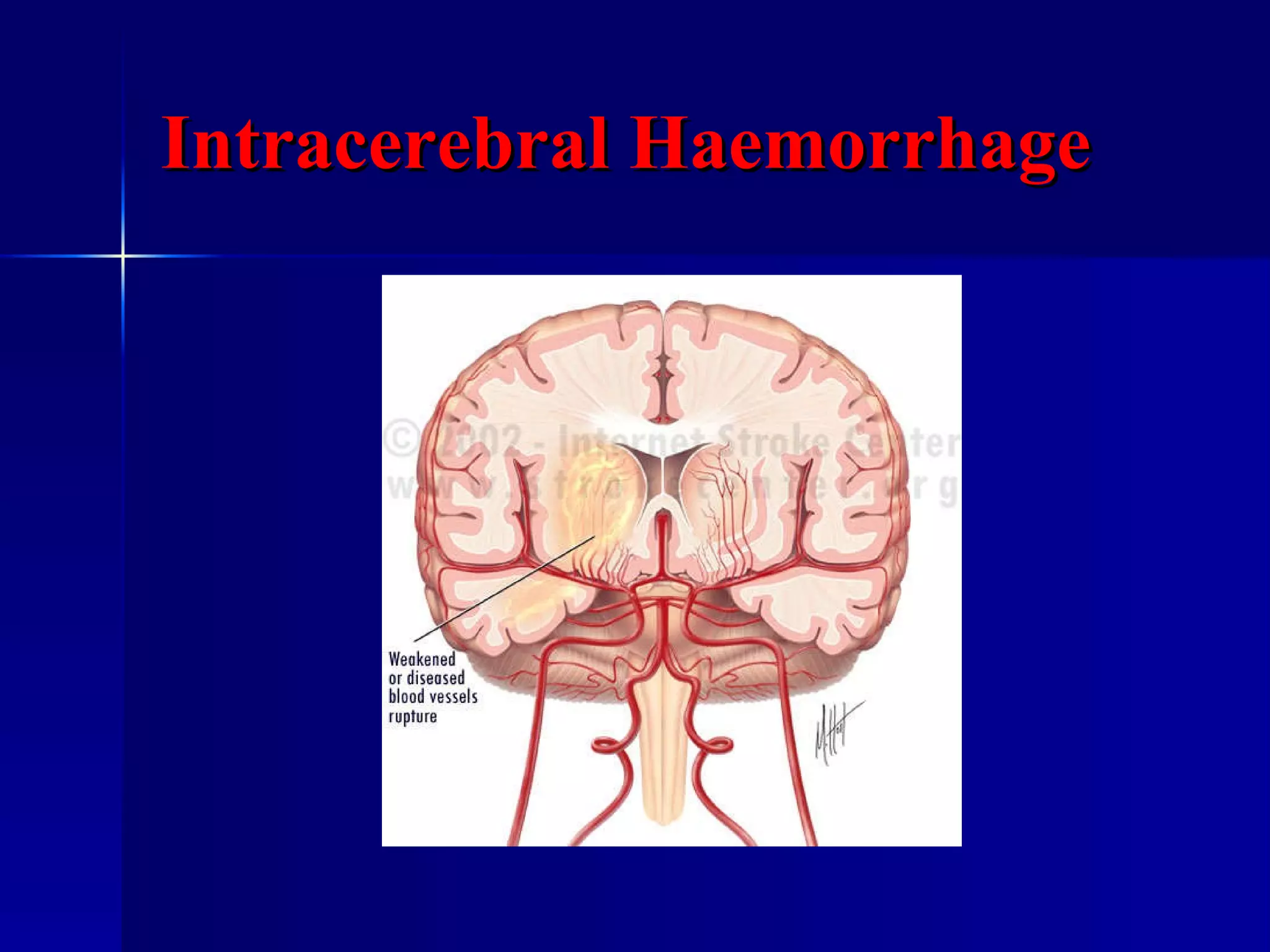 Intracerebral Haemorrhage 