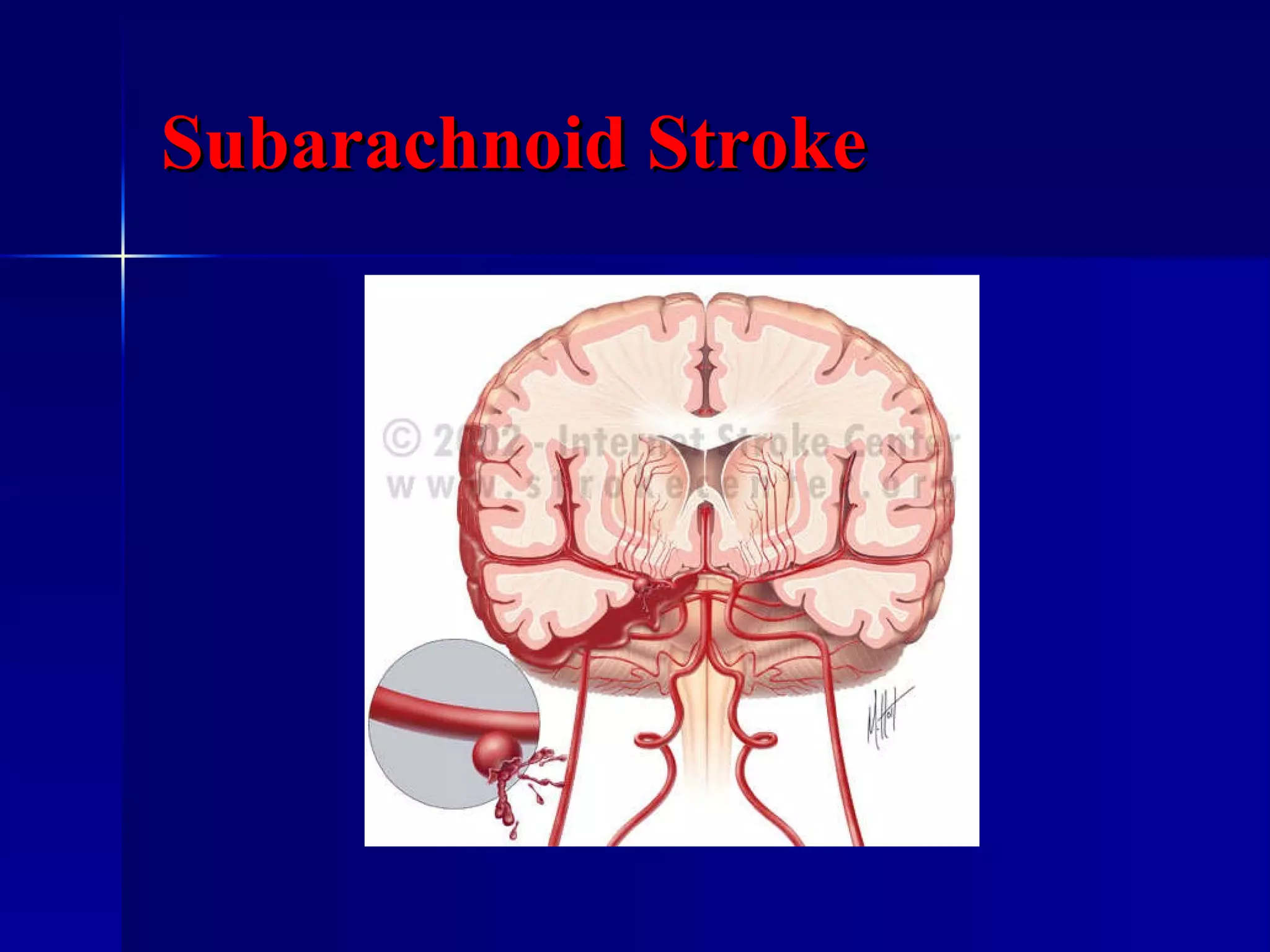Subarachnoid Stroke 