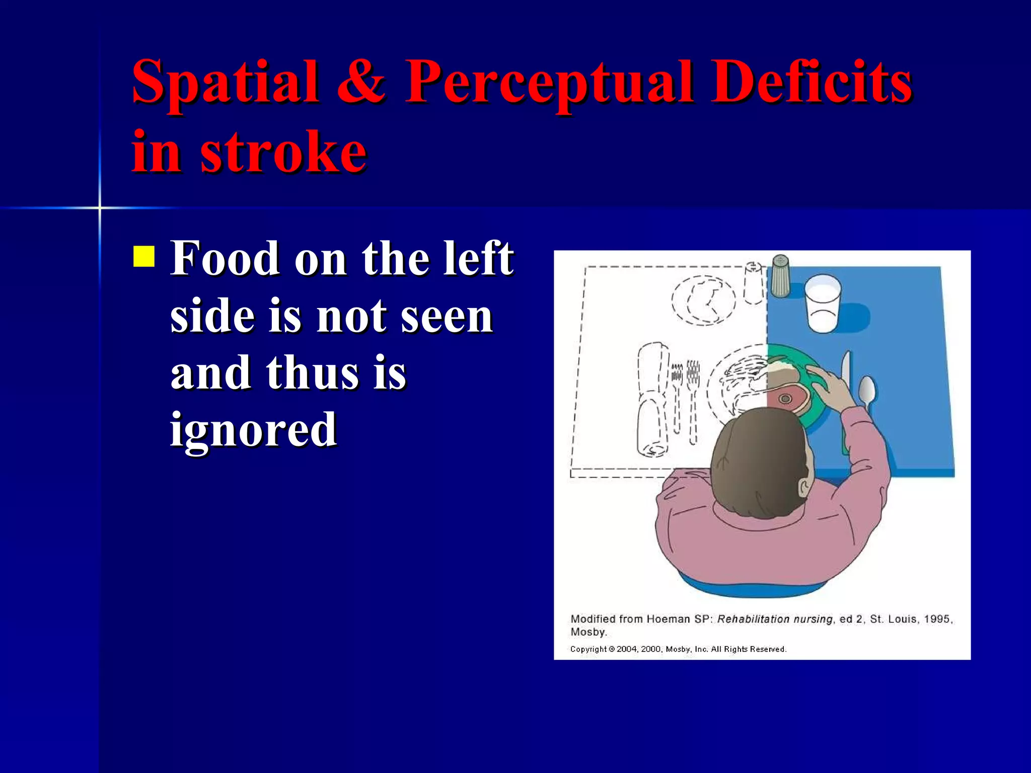 Spatial & Perceptual Deficits in stroke Food on the left side is not seen and thus is ignored 