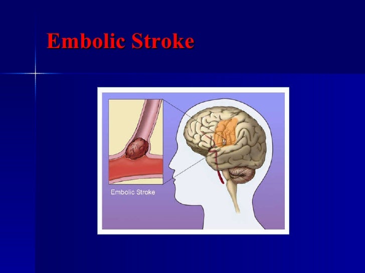 Stroke Ppt July 2006