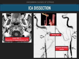 Stroke - Uncommon Causes of Stroke and Other CVD.pdf