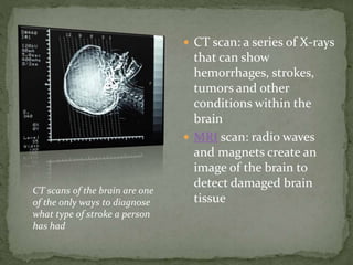  CT scan: a series of X-rays
that can show
hemorrhages, strokes,
tumors and other
conditions within the
brain
 MRI scan: radio waves
and magnets create an
image of the brain to
detect damaged brain
tissue
CT scans of the brain are one
of the only ways to diagnose
what type of stroke a person
has had
 