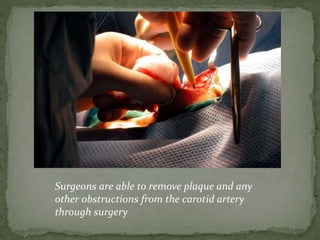 Surgeons are able to remove plaque and any
other obstructions from the carotid artery
through surgery
 