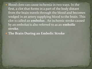  Blood clots can cause ischemia in two ways. In the
first, a clot that forms in a part of the body distant
from the brain travels through the blood and becomes
wedged in an artery supplying blood to the brain. This
clot is called an embolus . An ischemic stroke caused
by an embolus is also referred to as an embolic
stroke.
 The Brain During an Embolic Stroke
 