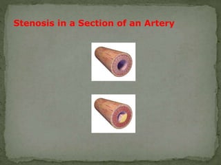 Stenosis in a Section of an Artery
 