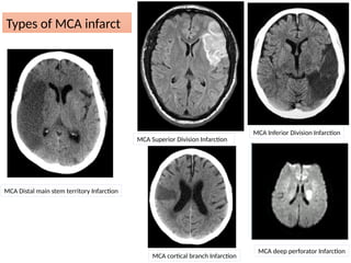 Perforator Infarction stroke 2.pptxinfianepalchinaindianepalchina | PPTX