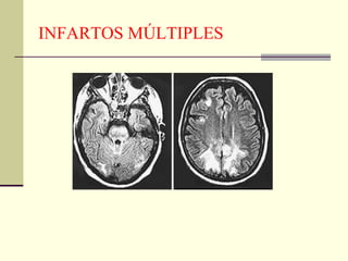 INFARTOS MÚLTIPLES
 