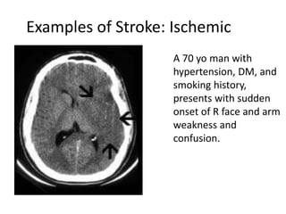 Stroke by Mwebaza Victor | PPT