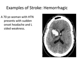 Stroke by Mwebaza Victor | PPT