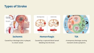 Types of Stroke
Ischemic
Caused by a blockage (clot or plaque)
in a brain vessel.
Hemorrhagic
Caused by a ruptured blood vessel
bleeding into the brain.
TIA
A temporary blockage causing
transient stroke symptoms.
 