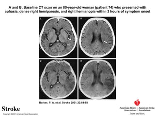 Copyright ©2001 American Heart Association Barber, P. A. et al. Stroke 2001;32:84-88 A and B, Baseline CT scan on an 80-year-old woman (patient 74) who presented with aphasia, dense right hemiparesis, and right hemianopia within 3 hours of symptom onset 