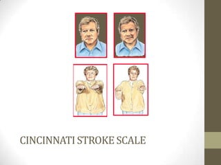 CINCINNATI STROKE SCALE