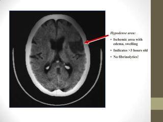 Hypodense area:Ischemic area with edema, swelling