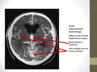 No fibrinolytics!(White areas indicate hyperdensity = blood)Large left frontalintracerebral hemorrhage.Intraventricularbleeding is also presentNo fibrinolytics!