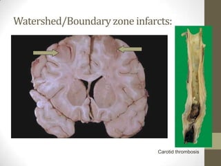 Watershed/Boundary zone infarcts:Carotid thrombosis