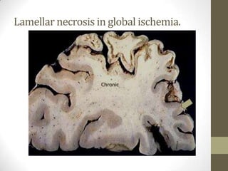 Lamellar necrosis in global ischemia.Chronic