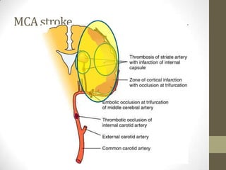 MCA stroke.