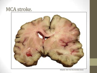 MCA stroke.Wikipedia: GNU Free Documentation license 