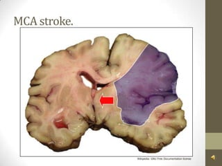 MCA stroke.Wikipedia: GNU Free Documentation license 