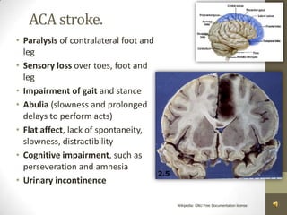 ACA stroke.Paralysis of contralateral foot and legSensory loss over toes, foot and legImpairment of gait and stanceAbulia (slowness and prolonged delays to perform acts)Flat affect, lack of spontaneity, slowness, distractibilityCognitive impairment, such as perseveration and amnesiaUrinary incontinenceWikipedia: GNU Free Documentation license 