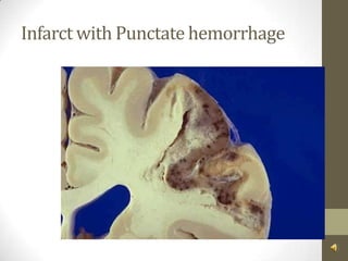 Infarct with Punctate hemorrhage