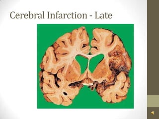Cerebral Infarction - Late