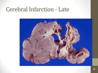 Cerebral Infarction - Late