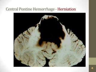 Central Pontine Hemorrhage - Herniation