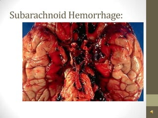 Subarachnoid Hemorrhage:
