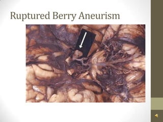Ruptured Berry Aneurism