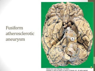 Fusiform atherosclerotic aneurysm