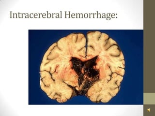 Intracerebral Hemorrhage: