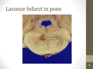 Lacunar Infarct in pons 