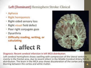 Left (Dominant) Hemisphere Stroke: ClinicalAphasiaRighthemiparesisRight-sided sensory loss Right visual field defect Poor right conjugate gaze Dysarthria Difficulty reading, writing, or calculatingL affect RDiagnosis: Recent cerebral infarction in left MCA distribution.Left cerebral hemisphere shows swelling with compression of the lateral ventricle mainly in the frontal area, due to recent infarct in the Middle Cerebral Artery (MCA) distribution. The brain in the MCA area shows discoloration of the cortex and also blurring between the cortex and white matter. 