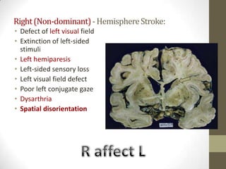 Right (Non-dominant) - Hemisphere Stroke:Defect of left visual field Extinction of left-sided stimuli Left hemiparesisLeft-sided sensory loss Left visual field defect Poor left conjugate gaze Dysarthria Spatial disorientation R affect L