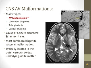 CNS AV Malformations:Many types:AV Malformation *Cavernous angiomaTelangiectasiaVenous angiomaCause of Seizure disorders & hemorrhage.Most common congenital vascular malformation.Typically located in the outer cerebral cortex underlying white matter.