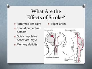 What Are the
Effects of Stroke?
O Paralyzed left sight
O Spatial perceptual
defects
O Quick impulsive
behavioral style
O Memory deficits
O Right Brain
 