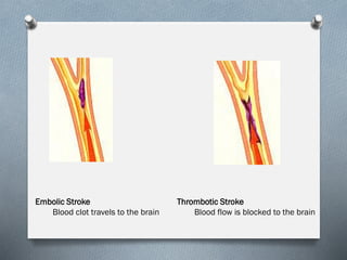 Embolic Stroke
Blood clot travels to the brain
Thrombotic Stroke
Blood flow is blocked to the brain
 