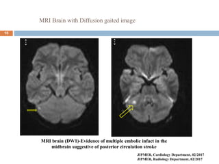 MRI Brain with Diffusion gaited image
10
MRI brain (DW1)-Evidence of multiple embolic infact in the
midbrain suggestive of posterior circulation stroke
JIPMER, Cardiology Department, 02/2017
JIPMER, Radiology Department, 02/2017
 