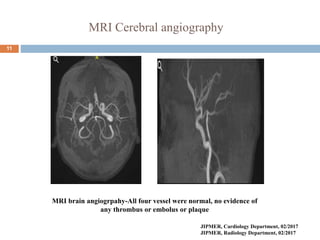 MRI Cerebral angiography
11
MRI brain angiogrpahy-All four vessel were normal, no evidence of
any thrombus or embolus or plaque
JIPMER, Cardiology Department, 02/2017
JIPMER, Radiology Department, 02/2017
 